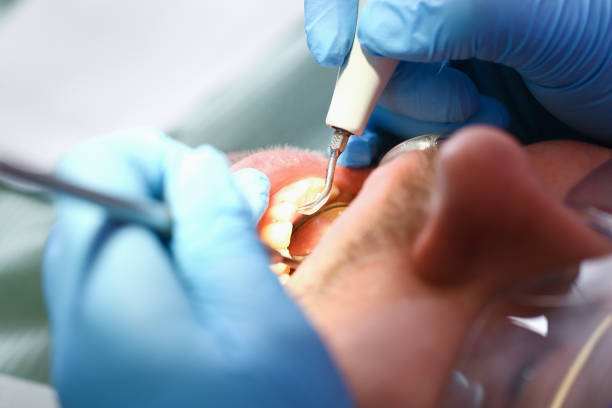 Best Emergency Root Canal Treatment in Llano Grande, TX
